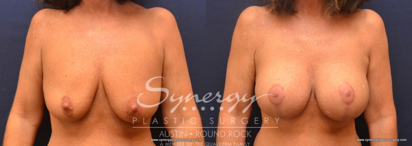 Before & After Breast Lift & Breast Augmentation Case 652 View #1 View in Austin, TX