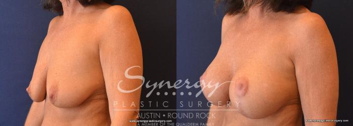 Before & After Breast Lift & Breast Augmentation Case 652 View #2 View in Austin, TX