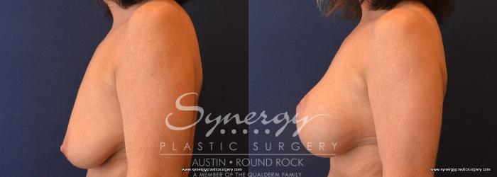 Before & After Breast Lift & Breast Augmentation Case 652 View #3 View in Austin, TX