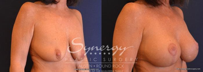 Before & After Breast Lift & Breast Augmentation Case 652 View #4 View in Austin, TX