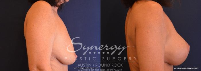 Before & After Breast Lift & Breast Augmentation Case 652 View #5 View in Austin, TX