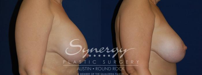 Before & After Breast Lift & Breast Augmentation Case 72 View #1 View in Austin, TX