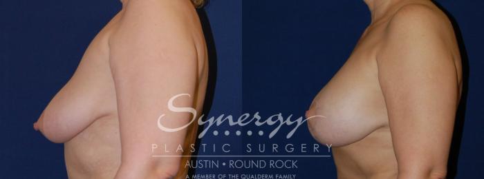 Before & After Breast Lift & Breast Augmentation Case 72 View #2 View in Austin, TX