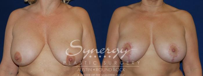 Before & After Breast Lift & Breast Augmentation Case 72 View #3 View in Austin, TX