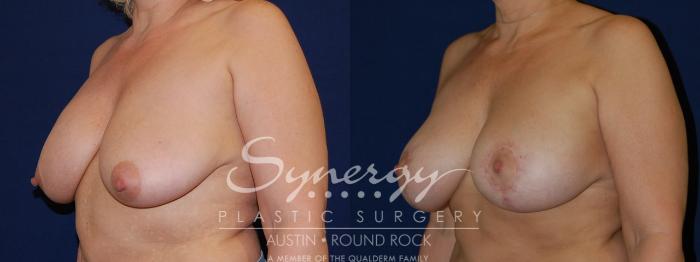 Before & After Breast Lift & Breast Augmentation Case 72 View #4 View in Austin, TX