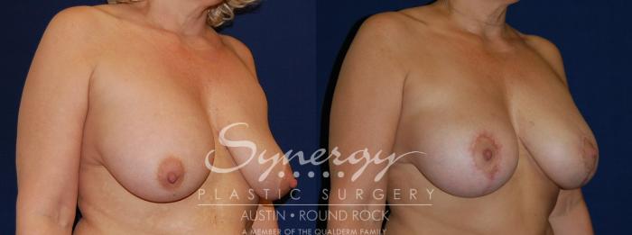 Before & After Breast Lift & Breast Augmentation Case 72 View #5 View in Austin, TX