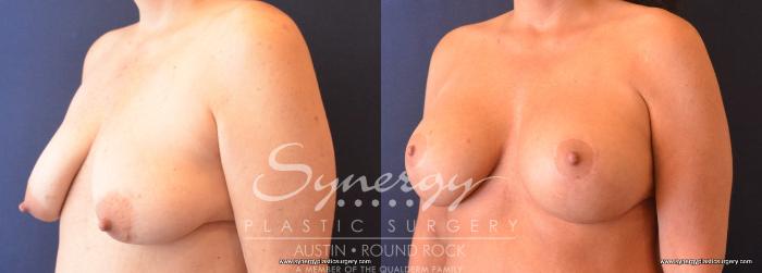 Before & After Breast Lift & Breast Augmentation Case 739 View #2 View in Austin, TX