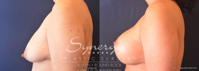 Before & After Breast Lift & Breast Augmentation Case 739 View #3 View in Austin, TX