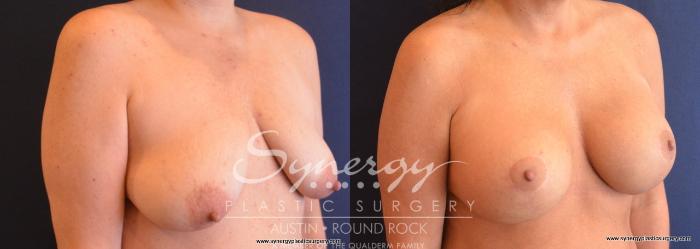 Before & After Breast Lift & Breast Augmentation Case 739 View #4 View in Austin, TX