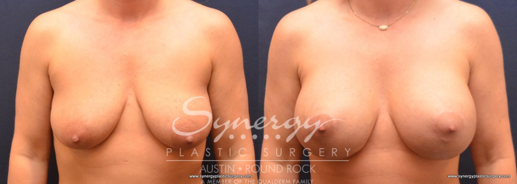 Before & After Breast Lift & Breast Augmentation Case 746 View #1 View in Austin, TX