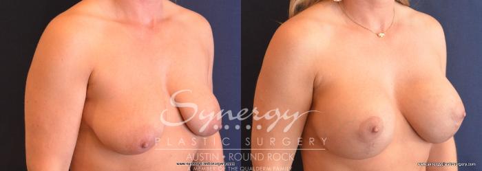 Before & After Breast Lift & Breast Augmentation Case 746 View #2 View in Austin, TX