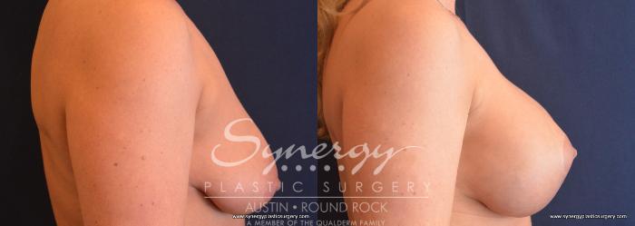 Before & After Breast Lift & Breast Augmentation Case 746 View #3 View in Austin, TX