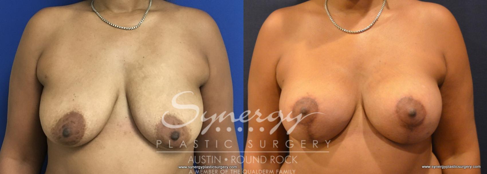 Before & After Breast Lift & Breast Augmentation Case 753 View #1 View in Austin, TX