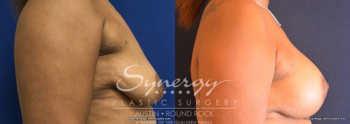 Before & After Breast Lift & Breast Augmentation Case 753 View #2 View in Austin, TX