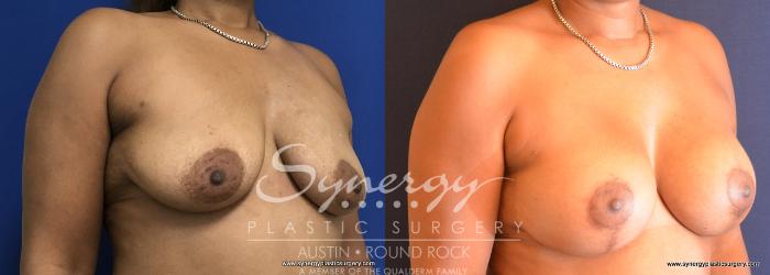 Before & After Breast Lift & Breast Augmentation Case 753 View #3 View in Austin, TX