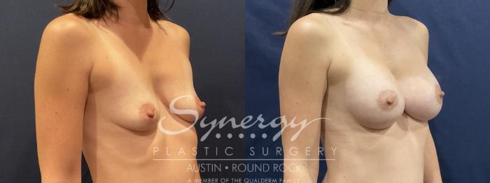 Before & After Breast Lift & Breast Augmentation Case 809 Left Oblique View in Austin, TX