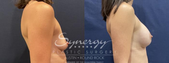 Before & After Breast Lift & Breast Augmentation Case 809 Left Side View in Austin, TX
