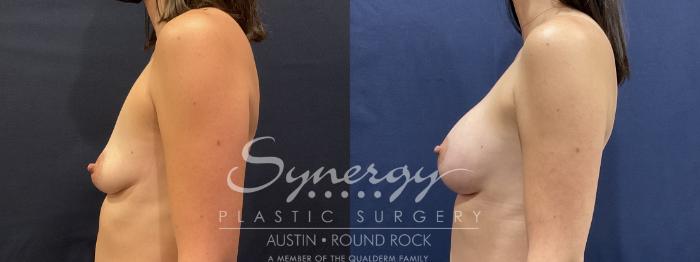 Before & After Breast Lift & Breast Augmentation Case 809 Right Side View in Austin, TX
