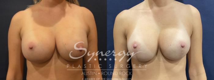 Before & After Breast Lift & Breast Augmentation Case 817 Front View in Austin, TX