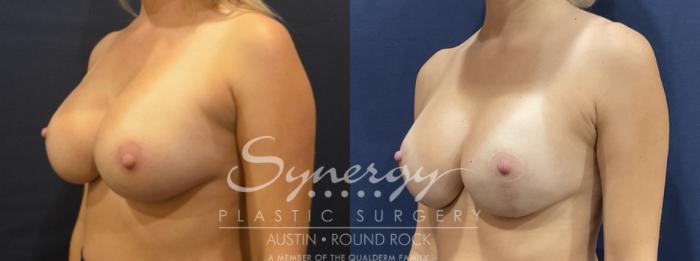 Before & After Breast Lift & Breast Augmentation Case 817 Left Oblique View in Austin, TX