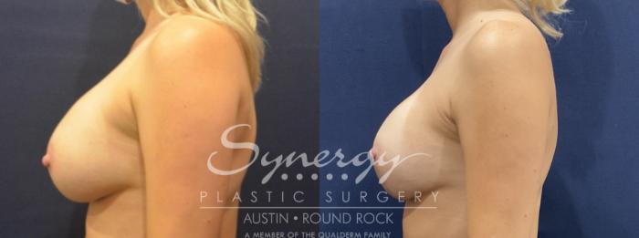 Before & After Breast Lift & Breast Augmentation Case 817 Left Side View in Austin, TX