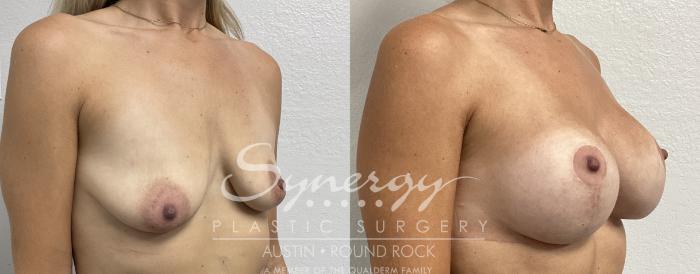 Before & After Breast Lift & Breast Augmentation Case 861 Left Oblique View in Austin, TX