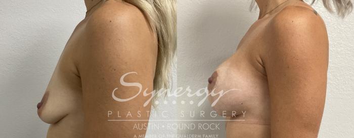 Before & After Breast Lift & Breast Augmentation Case 861 Right Side View in Austin, TX
