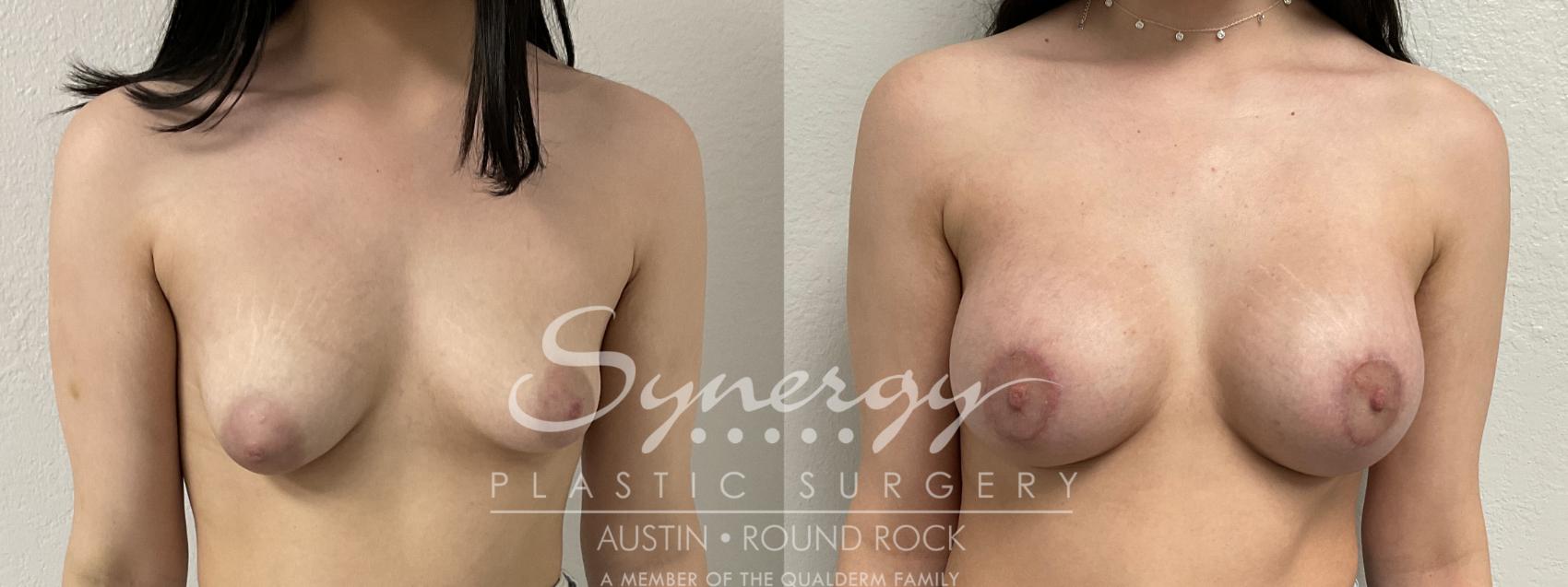 Before & After Breast Lift & Breast Augmentation Case 869 Front View in Austin, TX