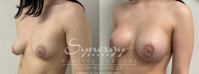 Before & After Breast Lift & Breast Augmentation Case 869 Right Oblique View in Austin, TX