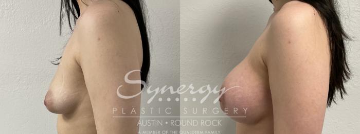 Before & After Breast Lift & Breast Augmentation Case 869 Right Side View in Austin, TX