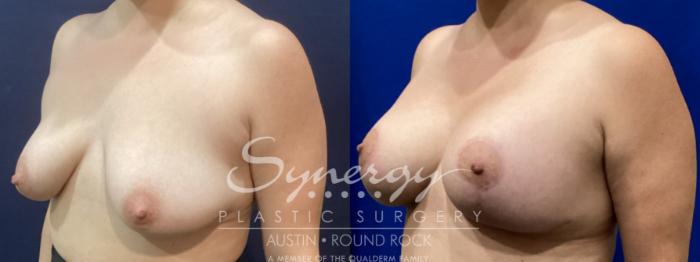 Before & After Breast Lift & Breast Augmentation Case 916 Left Oblique View in Austin, TX