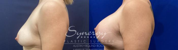 Before & After Breast Lift & Breast Augmentation Case 916 Left Side View in Austin, TX