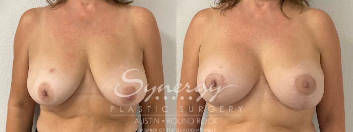 Before & After Breast Lift & Breast Augmentation Case 921 Front View in Austin, TX