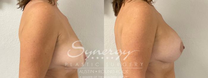 Before & After Breast Lift & Breast Augmentation Case 921 Right Side View in Austin, TX