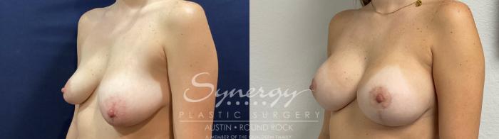 Before & After Breast Lift & Breast Augmentation Case 922 Left Oblique View in Austin, TX