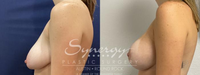 Before & After Breast Lift & Breast Augmentation Case 922 Left Side View in Austin, TX