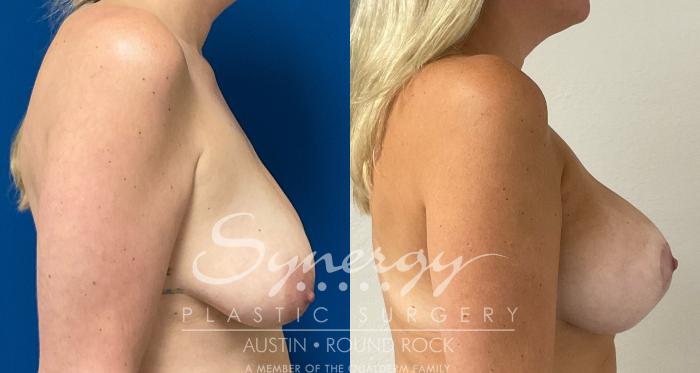 Before & After Breast Lift & Breast Augmentation Case 935 Right Side View in Austin, TX