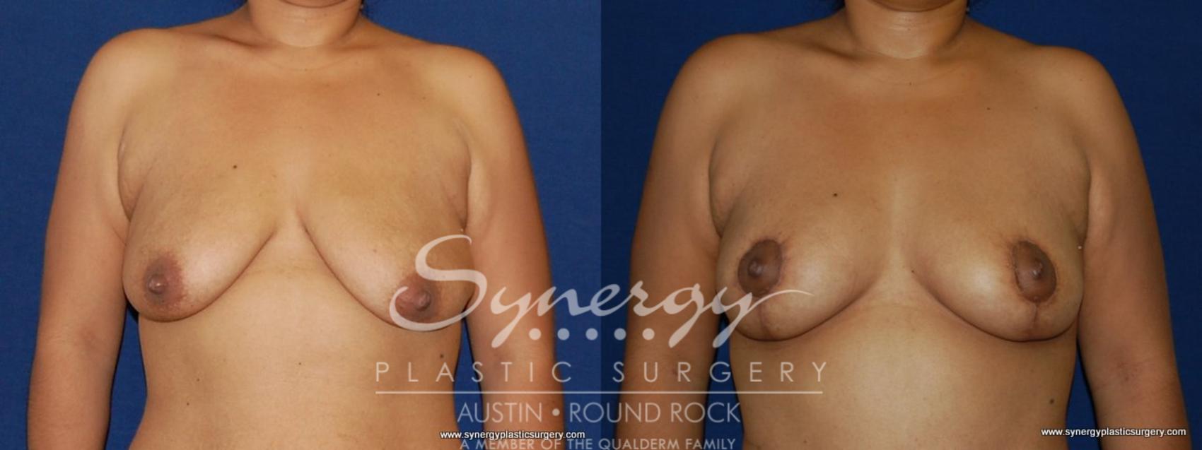 Before & After Breast Lift (Mastopexy) Case 155 View #1 View in Austin, TX