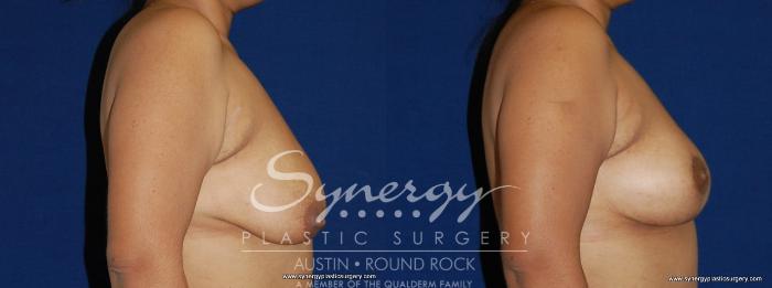 Before & After Breast Lift (Mastopexy) Case 155 View #2 View in Austin, TX