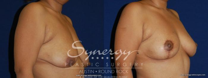 Before & After Breast Lift (Mastopexy) Case 155 View #4 View in Austin, TX