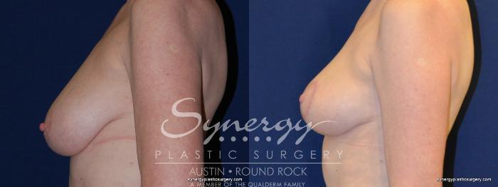 Before & After Breast Lift (Mastopexy) Case 213 View #1 View in Austin, TX
