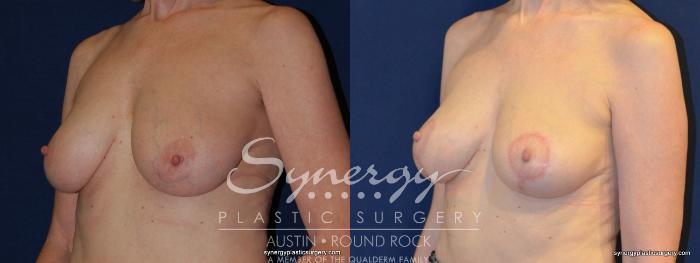 Before & After Breast Lift (Mastopexy) Case 213 View #2 View in Austin, TX