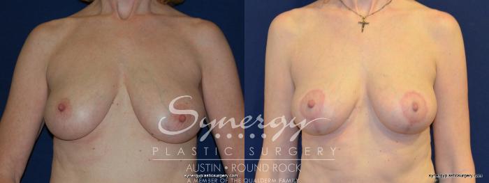Before & After Breast Lift (Mastopexy) Case 213 View #3 View in Austin, TX