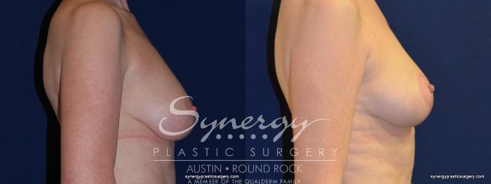 Before & After Breast Lift (Mastopexy) Case 213 View #4 View in Austin, TX
