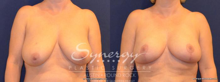 Before & After Breast Lift (Mastopexy) Case 332 View #1 View in Austin, TX