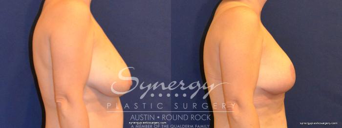 Before & After Breast Lift (Mastopexy) Case 332 View #2 View in Austin, TX