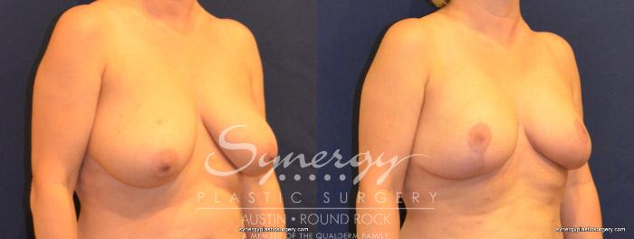 Before & After Breast Lift (Mastopexy) Case 332 View #3 View in Austin, TX