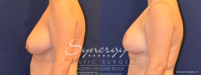 Before & After Breast Lift (Mastopexy) Case 332 View #4 View in Austin, TX