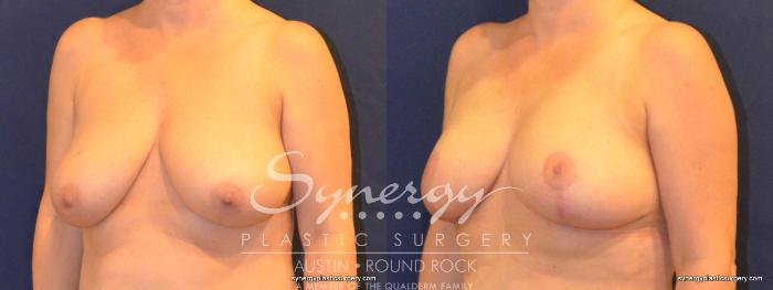 Before & After Breast Lift (Mastopexy) Case 332 View #5 View in Austin, TX