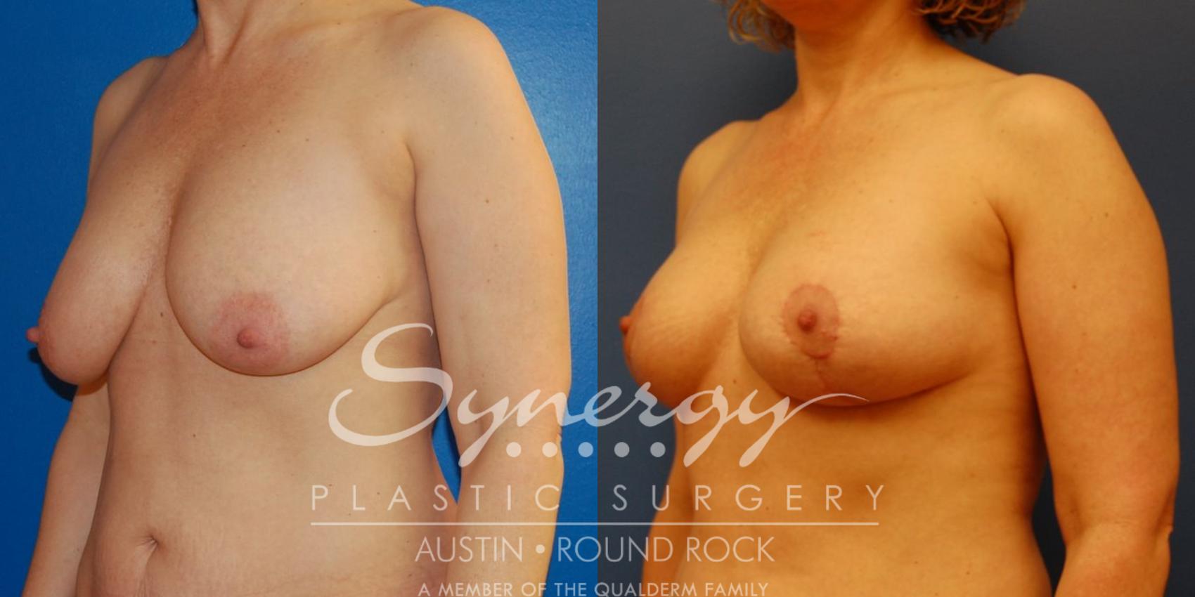 Before & After Breast Lift (Mastopexy) Case 39 View #2 View in Round Rock, TX